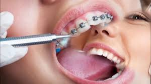 Harga pakai braces di klinik kerajaan. Lepas Harga Minyak Naik Caj Rawatan Gigi Di Klinik Kerajaan Pula Naik By Azman Manzg