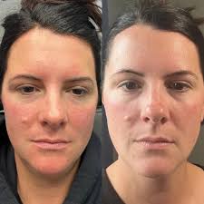 🫶🏼 We are in the business of making you all pretty, but sometimes we need  to chat about the ugly! So real talk. When you're receiving a dermal filler  treatment consultation, the #