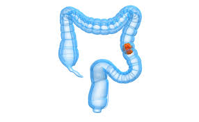 Blood in the stool, for example, which is a warning sign of cancer , may also happen as a result of a. Bowel Cancer Ulcerative Colitis And Crohn S Disease