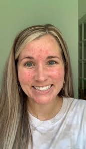 Here's my “before and after” from yesterday's video!!! If you strugggle  with redness, acne or melasma, watch my video to see how I minimize the  appearance of these