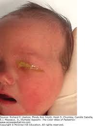 Image result for Gonococcal Conjunctivitis