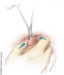 See full list on doctorshealthpress.com Minimal Excision Technique For Epidermoid Sebaceous Cysts American Family Physician