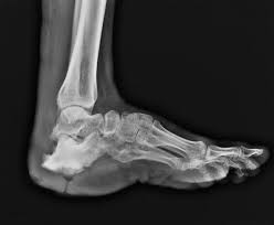 Image result for Osteomyelitis XRay