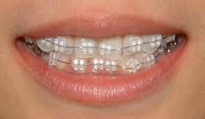 Lingual braces are fixed behind the teeth to make them almost undetectable. Pin On Braces