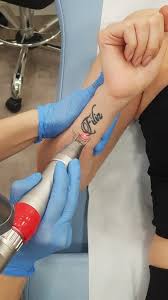 Bunun için internet üzerinden çeşitli dövme tasarımlarına bakabilirsiniz. Lazer Ile Dovme Sildirme Dk Klinik Antalya