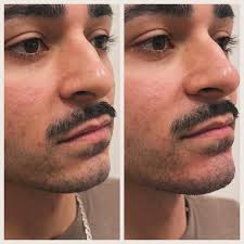 Isaac Waalen, PA-C 💉 (@injectedbyisaac) • Instagram photos and videos