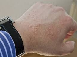 Image result for scabies human bites