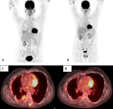 Eighty percent of all cases are pleural in origin. Morphologic And Functional Imaging Of Malignant Pleural Mesothelioma Sciencedirect