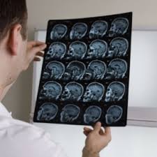 Originea tumorală a hidrocefaliei este 4. Hematomul Subdural Simptome Diagnostic Tratament