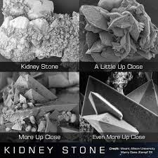 Piedras Del Rinon Vistas Con Microscopio Microscopio Rinones Calculos Renales