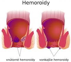 Lekarz powiedział, że tak będzie trzy razy dziennie parfina ciekła i dieta raczej płynna.duzo owocow i warzyw. Hemoroidy Priznaky Domaca Liecba Vsetko O Zlatej Zile Zdravovek