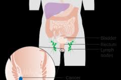 Being able to distinguish between the two can be the difference between uncomfortable bowel motions and something more serious. Anal Cancer Symptoms Causes And Treatments Health Care Qsota