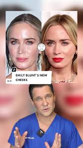 Did Emily Blunt do something to her cheeks? #EmilyBlunt #EmilyBluntUpdates  #HollywoodPlasticSurgery #CelebritySurgery #CelebritySurgeries  #CelebrityFace #PlasticSurgery #PlasticSurgeryTikTok ...