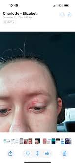 Why are my eyelids burning :(