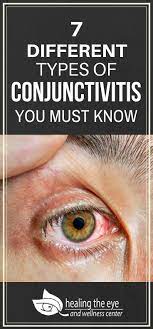 Learn About The Different Types Of Conjunctivitis Here Pinkeye Eyecare Http Www Healingtheeye Com Types Conjunctivi Dry Eye Remedies Conjunctivitis Eyes