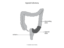 Colon anastomosis leakage, computed tomography, postoperative peritonitis. Bowel Resection Canadian Cancer Society