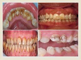 Image result for Tooth Discoloration