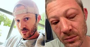 Zach Gilford Shares Photos Of His Swollen Face After Health Scare