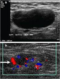 About 4 months ago while i was in class i noticed a lump on my left collar bone. Lymphadenopathy Wikipedia