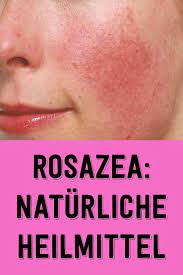 Rosazea Naturliche Heilmittel What Is Vitiligo Rosacea Face Care