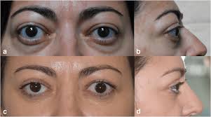 Case 2: Graves' ophthalmopathy patient with bilateral asymmetric...