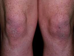 Image result for Dermatomyositis