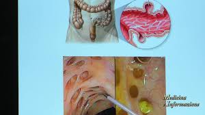 Ecco un esempio della dieta e cosa mangiare per la diverticolite: Diverticoli Come Prevenirli Cosa Mangiare Per Evitare Che Si Infiammino Youtube