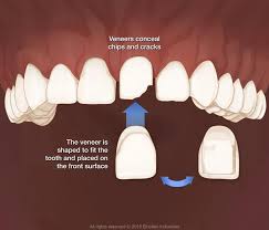 How long do porcelain veneers last? Veneers Amarillo Tx Porcelain Veneers Pendergrass And Wilkie Dentistry