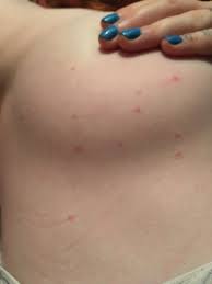 Are These Flea Bites Tmi Glow Community