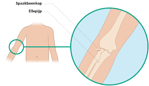 Radius, radius, radial, the radius, spoke bone. Informatie Keuzehulp