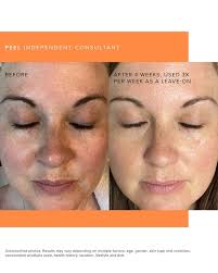 Some before and afters from our newest innovation Muti-acid Enzyme Peel!!  Go ahead and check these out!!