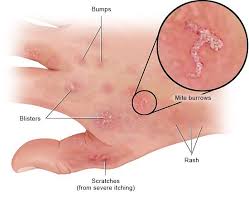 Image result for scabies human bites