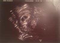 Mit dem ende der 3. 6 5 Aber Embryo Nur 3mm Gross Forum Schwangerschaft Urbia De