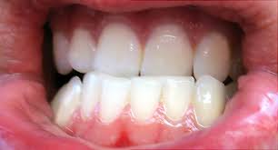 Should your teeth touch when sleeping? Grind Your Teeth At Night Botox Might Help Webmd