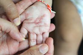 What is scabies, what causes it, and how it is treated? Scabies In Babies Causes Signs Treatment And Remedies