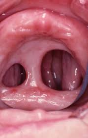 Syphilis infection progresses in three stages, oral syphilis is identified by cold sores also known as chancres around the oral cavity. Three Cases Of Oral Syphilis An Overview British Dental Journal