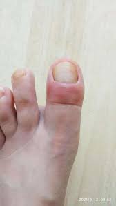 Image result for Akutní zánět nehtového lůžka