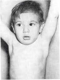 Acta Paediatrica 18. (1977)