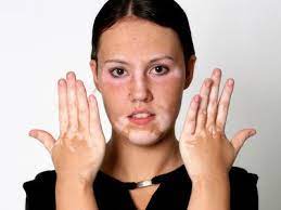 hypopigmentation healthy skin solutions vitiligo cure vitiligo treatment vitiligo
