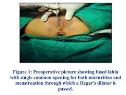 Image result for Labial Fusion