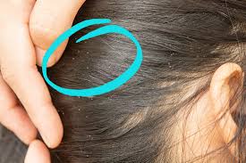 Image result for lice vs dandruff