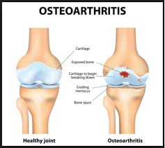 It is created by taking a small sample of blood and spinning it in a centrifuge to separate the various cells and to concentrate the platelets. Why Platelet Rich Plasma Is The Most Effective Treatment For Knee Osteoarthritis West Coast Orthopedics