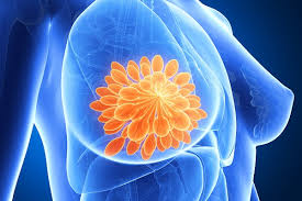 Treatment is also based on where the cancer started. Diagnosis Of Breast Cancer Symptoms Medicalnewshome