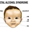 This is often associated with a broad flat nasal bridge. Https Encrypted Tbn0 Gstatic Com Images Q Tbn And9gctcqkcsxez4ncqz S8bwghkec4w6cav E E9ccg8ysel3dxjalh Usqp Cau