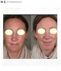 🥼🩺 Rhinoplasty by Dr. Milos Kovacevic 🥽 @dr.miloskovacevic ✓ Location:  Hamburg, Germany ☝️Website: www.dr-kovacevic.de ⭐️ 🌟 ⭐️ 🌹Our mission at  @facialplasticsphotos is to make quality information