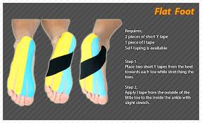 Flat Foot Is A Condition Where The Longitudinal Arch Or Instep Of The Foot Collapses And Comes In Contact With Th Kinesiology Taping Kinesiology Foot Exercises