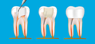 Mit einer wurzelbehandlung (wurzelkanalbehandlung) kann man eigene zähne länger erhalten. Praxis Fur Zahnheilkunde Schiffers Kollegen Wurzelbehandlung