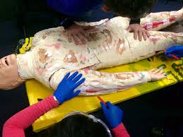 Lateral incisions are made on both sides of chest 2. Escharotomy Sydney Hems Blog Posts Operational Ems