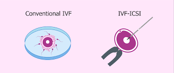 Most comprehensive inclusive cycles cost approximately $12,000 or more, and medications are an additional estimated amount of $5,000 to $6,000, depending on your protocol. What Is In Vitro Fertilization Ivf Process Cost Success Rates