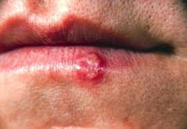 Infektionen Mit Herpes Simplex Viren Hsv Infektionen Msd Manual Ausgabe Fur Patienten